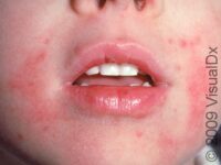 Eczema (Atopic Dermatitis)
