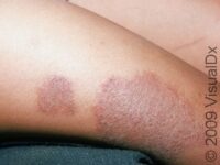 Eczema (Atopic Dermatitis)