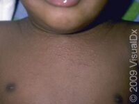 Eczema (Atopic Dermatitis)