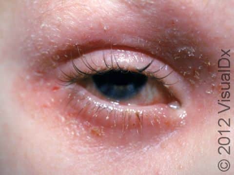 This image displays severe atopic dermatitis (eczema) on a child's eyelids.