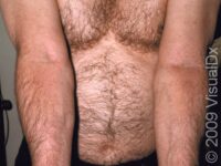 Eczema (Atopic Dermatitis)