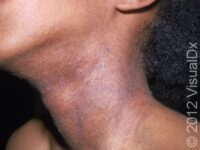 Eczema (Atopic Dermatitis)