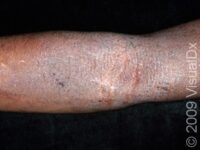 Eczema (Atopic Dermatitis)