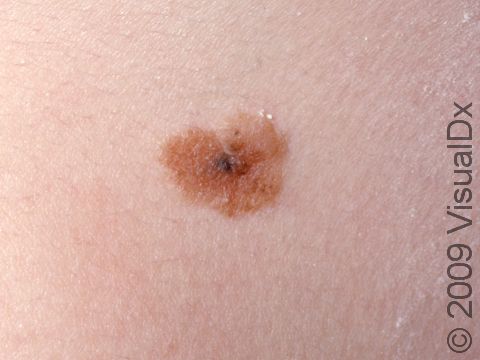 This image displays an atypical nevus (mole).