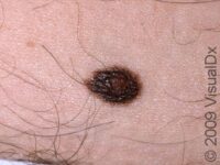 Mole, Atypical (Atypical Nevus)