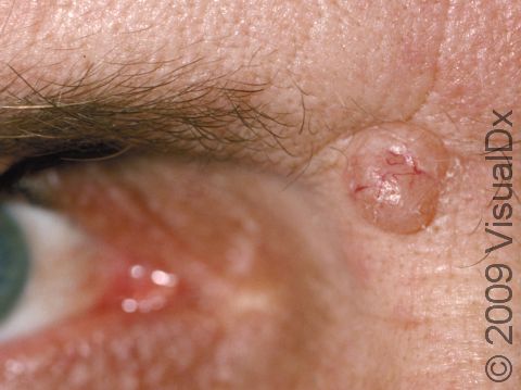 The nodular form of basal cell carcinoma is usually skin-colored with tiny blood vessels visible.