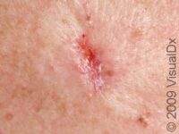 Basal Cell Carcinoma (BCC)