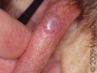 Basal Cell Carcinoma (BCC)