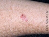 Basal Cell Carcinoma (BCC)