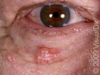 Basal Cell Carcinoma (BCC)