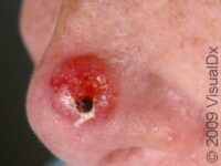 Basal Cell Carcinoma (BCC)