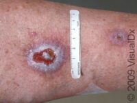 Basal Cell Carcinoma (BCC)