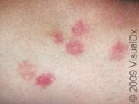 Bedbug Bite