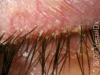 Blepharitis – Adult