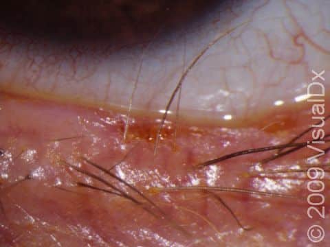 Chronic blepharitis can lead to misdirected eyelashes, misshapen eyelashes, and loss of eyelashes (trichiasis).