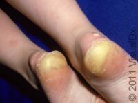 Callus