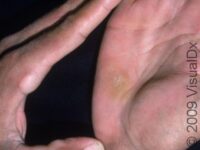 Callus