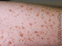 Capillaritis