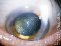 Cataracts