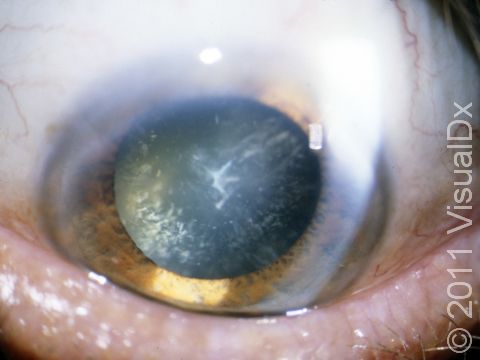 This image shows a cataract that is seen as white specks on the eye.