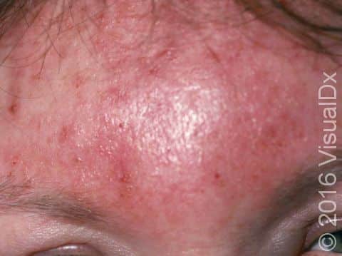 Cellulitis often causes warmth, redness, pain or tenderness, and skin swelling.