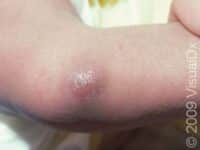 Cellulitis