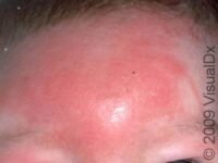 Cellulitis