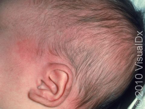 This image displays an infant with cellulitis of the scalp.