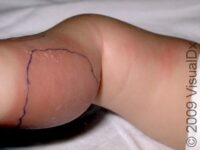 Cellulitis