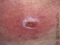 Cellulitis