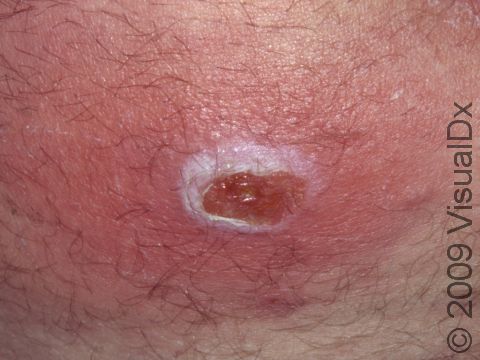 This image displays cellulitis.