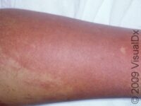 Cellulitis
