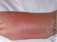 Cellulitis