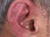 Cellulitis