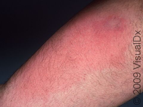 This image displays redness typical in the early stages of cellulitis.