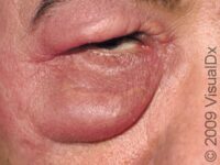 Cellulitis – Adult