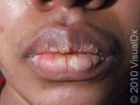Chapped Lips (Cheilitis)