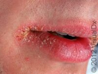 Chapped Lips (Cheilitis)