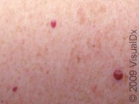 Cherry Hemangioma