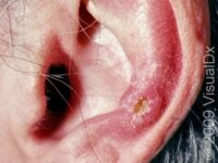Chondrodermatitis Nodularis Helicis