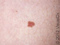 Mole (Nevus)