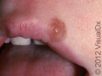 Mole (Nevus)