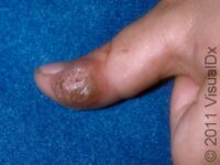 Common Wart – Child