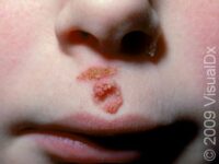 Common Wart