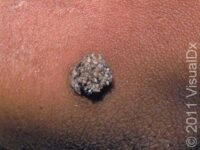 Common Wart