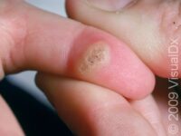 Common Wart