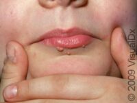 Common Wart