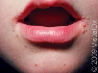 Common Wart
