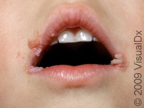 This image displays multiple warts on the lips.