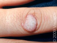 Common Wart